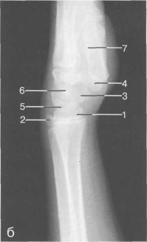 kuidas eemaldada ray-paagi liigese poletik valu jalgade sulgemine