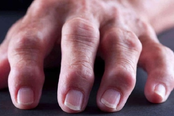 suurte sormede artriidi ravi kodus