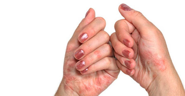 vaikeste sorme liigeste artriit