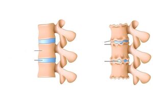 ribi liigeste artriit kui koigi liigeste artroos